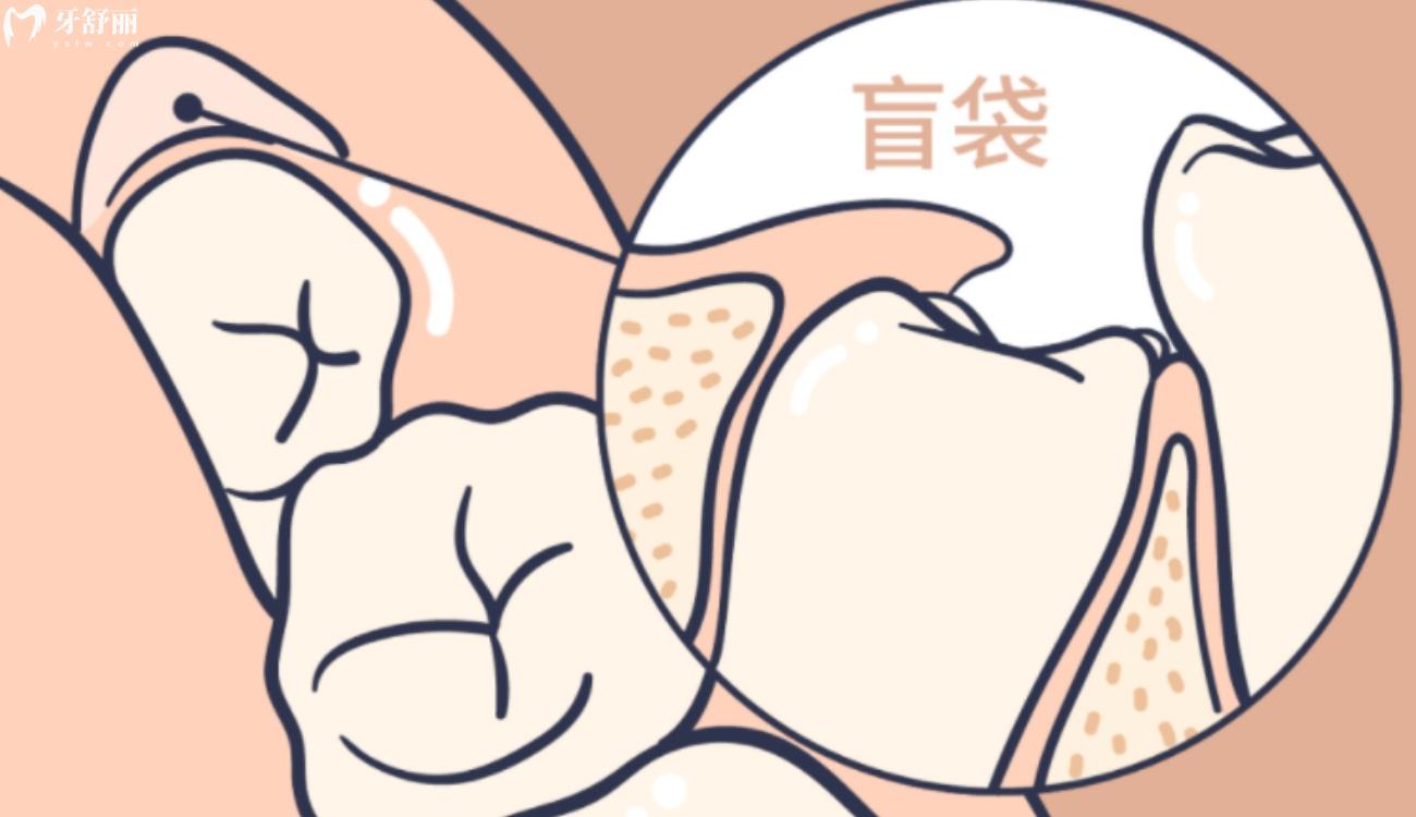 一次拔两颗智齿后悔死了.jpg 一次拔两颗智齿后悔死了.jpg