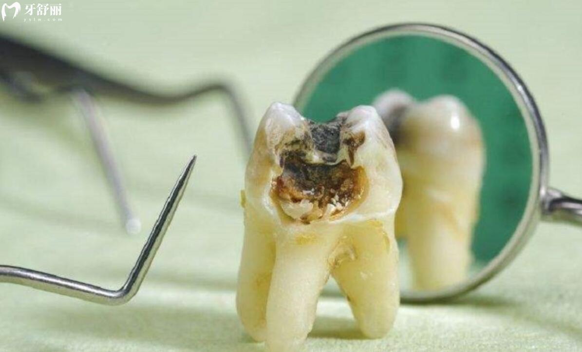 虫牙怎么治 虫牙怎么治