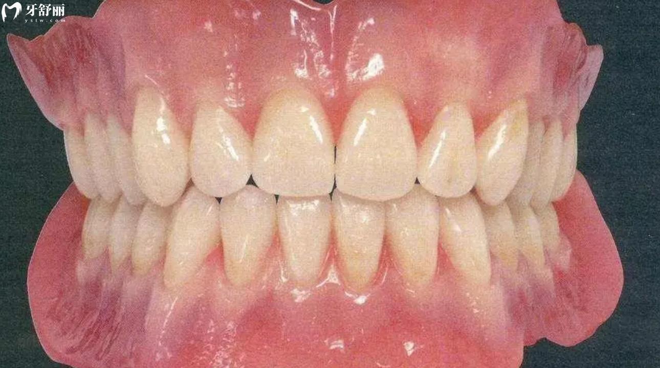 吸附性义齿有几种型号?吸附性义齿能使用多少年?