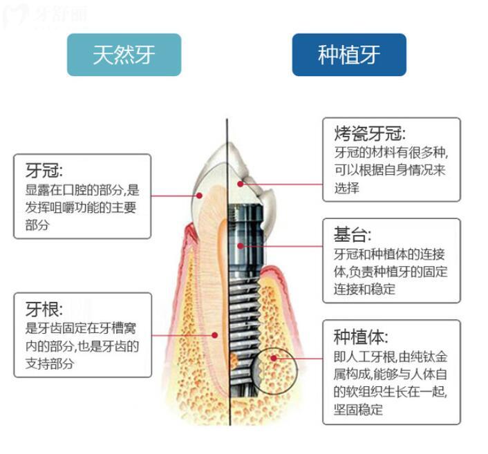 一篇告诉你如何选择陪伴下半辈子的种植牙 知道三点即可