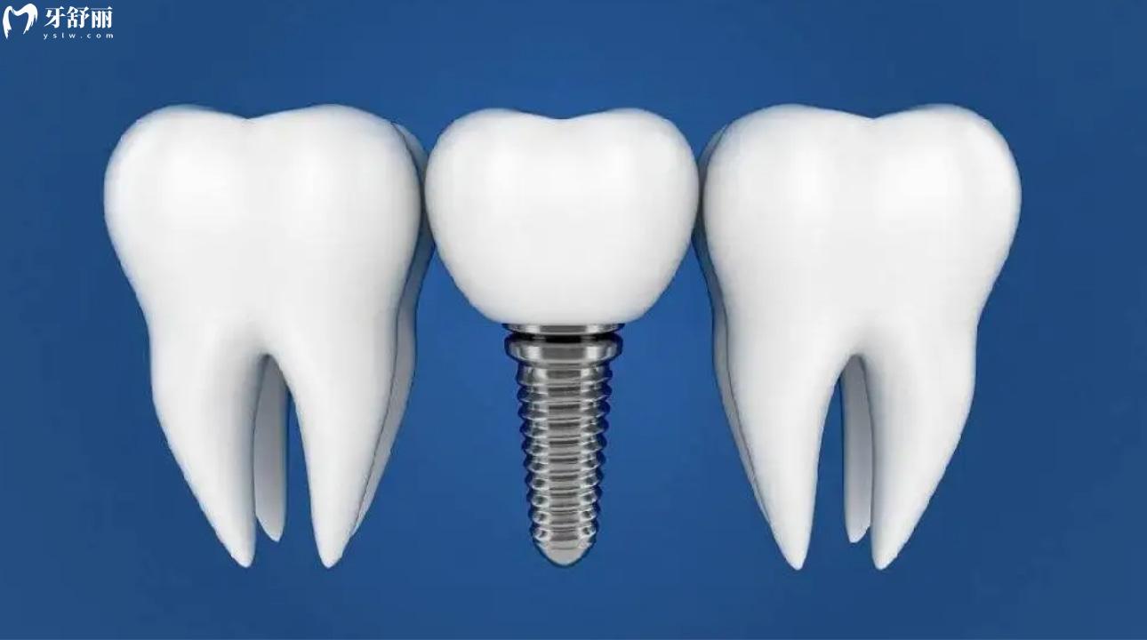 什么是骨水平种植体?骨水平种植体与软组织水平种植体的区别