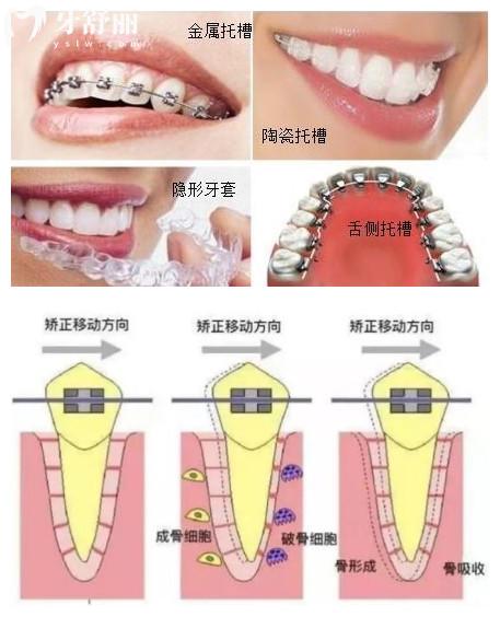 为什么不建议成年人做牙齿矫正，整完牙牙齿就变松动真的吗？