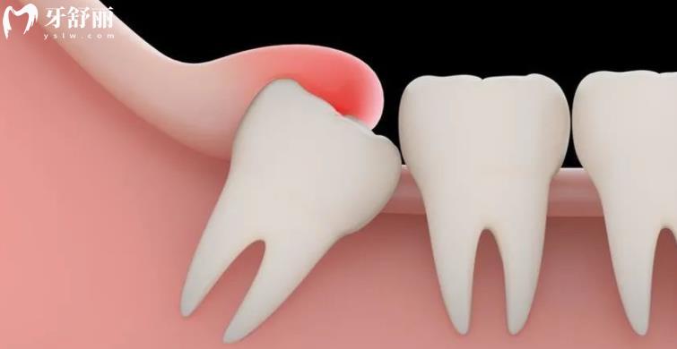 上海拔智齿能用<span style= 上海拔智齿能用<span style=