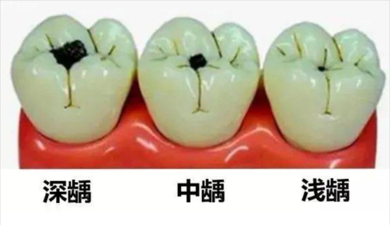 儿童补牙被忽悠做牙冠怎么办.jpg 儿童补牙被忽悠做牙冠怎么办.jpg