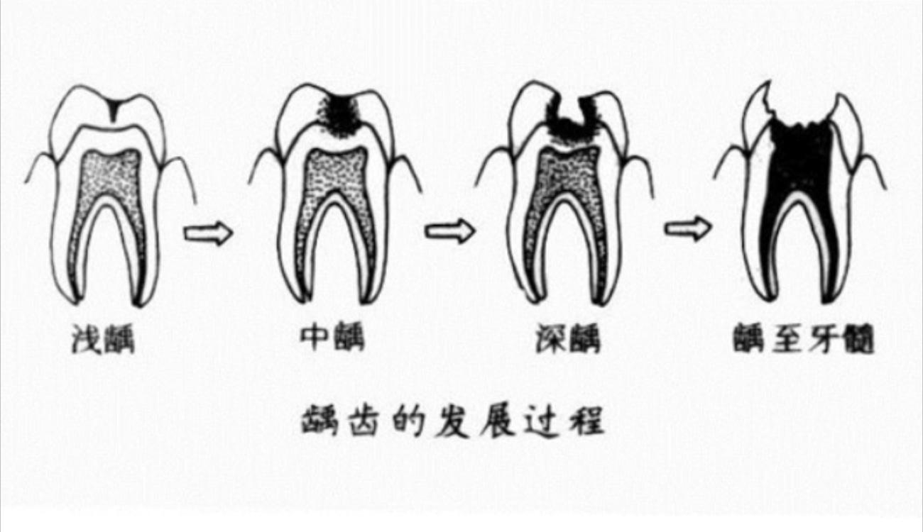 儿童补牙被忽悠做牙冠怎么办.jpg 儿童补牙被忽悠做牙冠怎么办.jpg