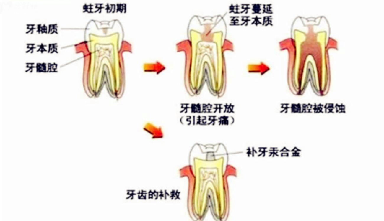 儿童补牙被忽悠做牙冠怎么办.jpg 儿童补牙被忽悠做牙冠怎么办.jpg