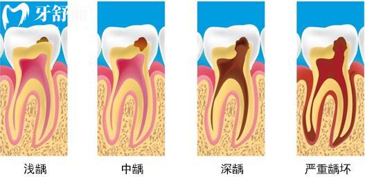 根管治疗为什么这么贵?利润这么高?看完原因就知道了 根管治疗为什么这么贵?利润这么高?看完原因就知道了