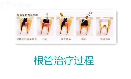 根管治疗为什么这么贵?利润这么高?看完原因就知道了 根管治疗为什么这么贵?利润这么高?看完原因就知道了