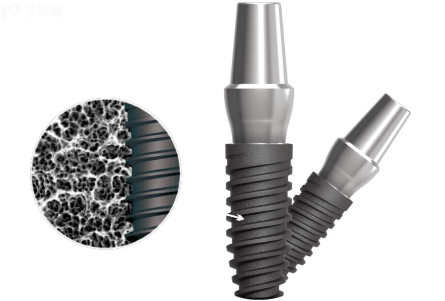 美国种植牙十大植体品牌及价格 美国种植牙十大植体品牌及价格