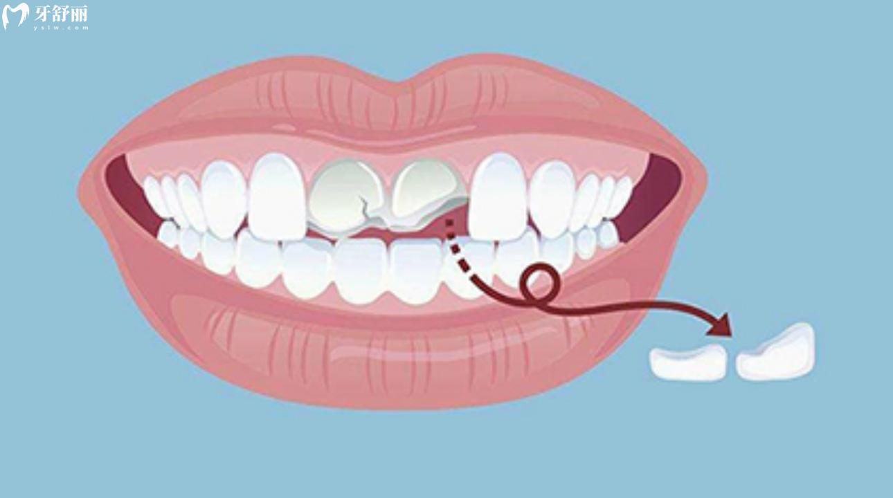 牙断了能保留牙根吗?牙齿断了一半修复价格? 牙断了能保留牙根吗?牙齿断了一半修复价格?