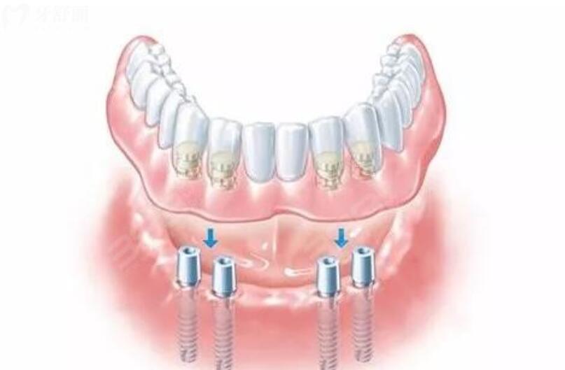 做半口种植牙需要多长时间 做半口种植牙需要多长时间