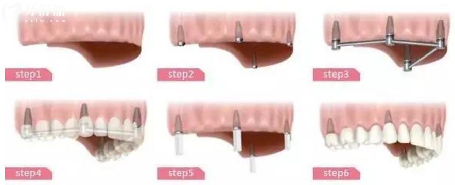 做半口种植牙需要多长时间 做半口种植牙需要多长时间