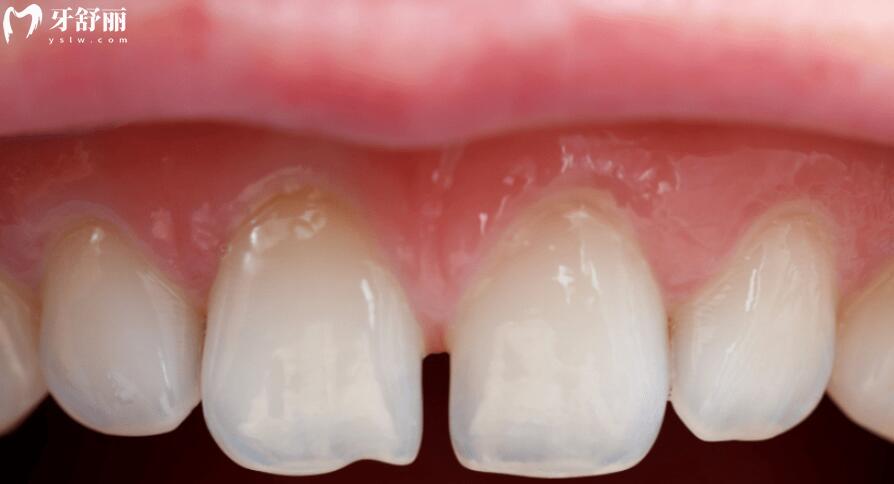 门牙缝隙大怎么办 门牙缝隙大怎么办