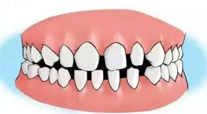门牙缝隙大怎么办 门牙缝隙大怎么办