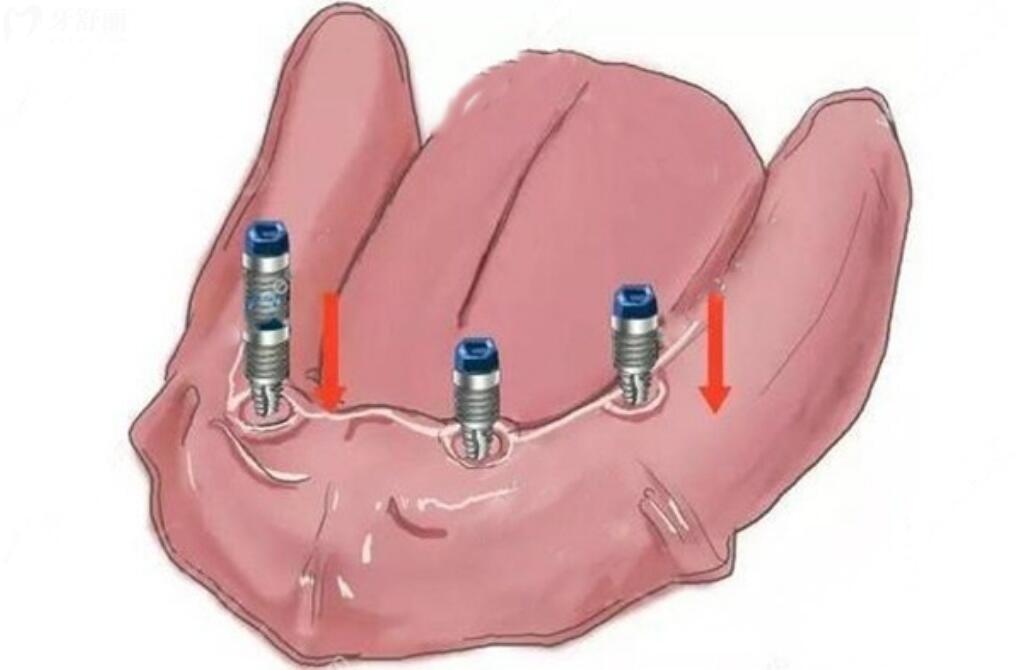 种一口牙需要种植几颗牙齿?价格费用是不是特别贵 种一口牙需要种植几颗牙齿?价格费用是不是特别贵