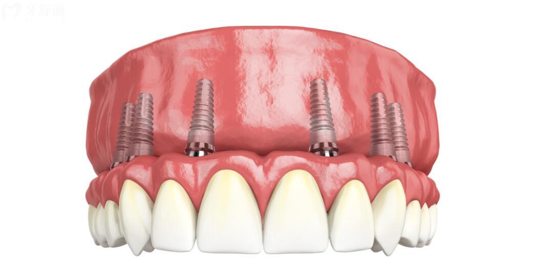 种一口牙需要种植几颗牙齿?价格费用是不是特别贵 种一口牙需要种植几颗牙齿?价格费用是不是特别贵