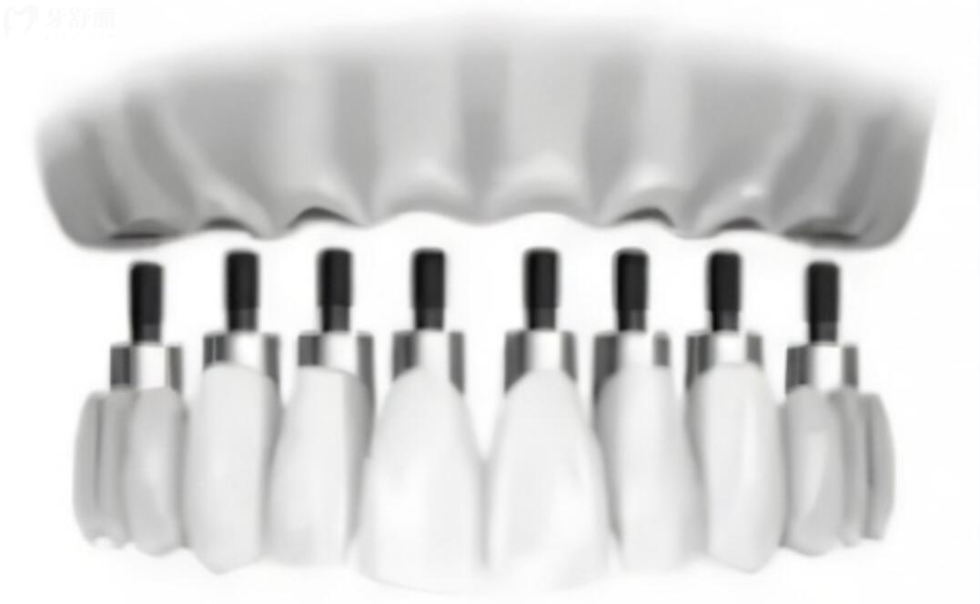 种一口牙需要种植几颗牙齿?价格费用是不是特别贵 种一口牙需要种植几颗牙齿?价格费用是不是特别贵