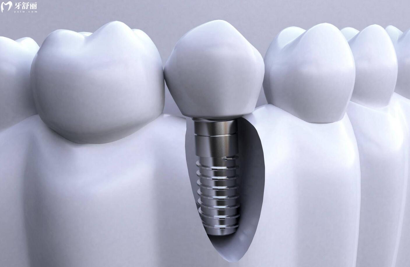 种一口牙需要种植几颗牙齿?价格费用是不是特别贵 种一口牙需要种植几颗牙齿?价格费用是不是特别贵