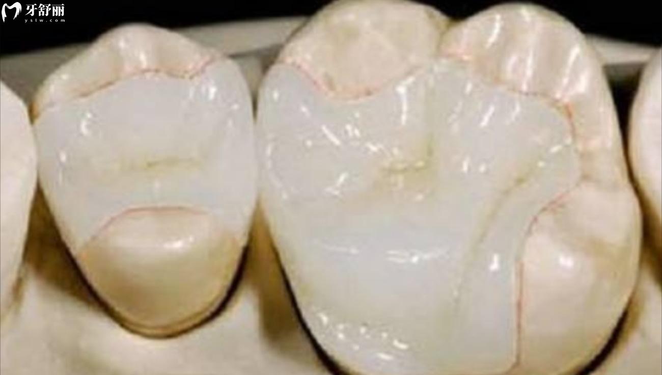 补牙的3m树脂材料价格2023.jpg