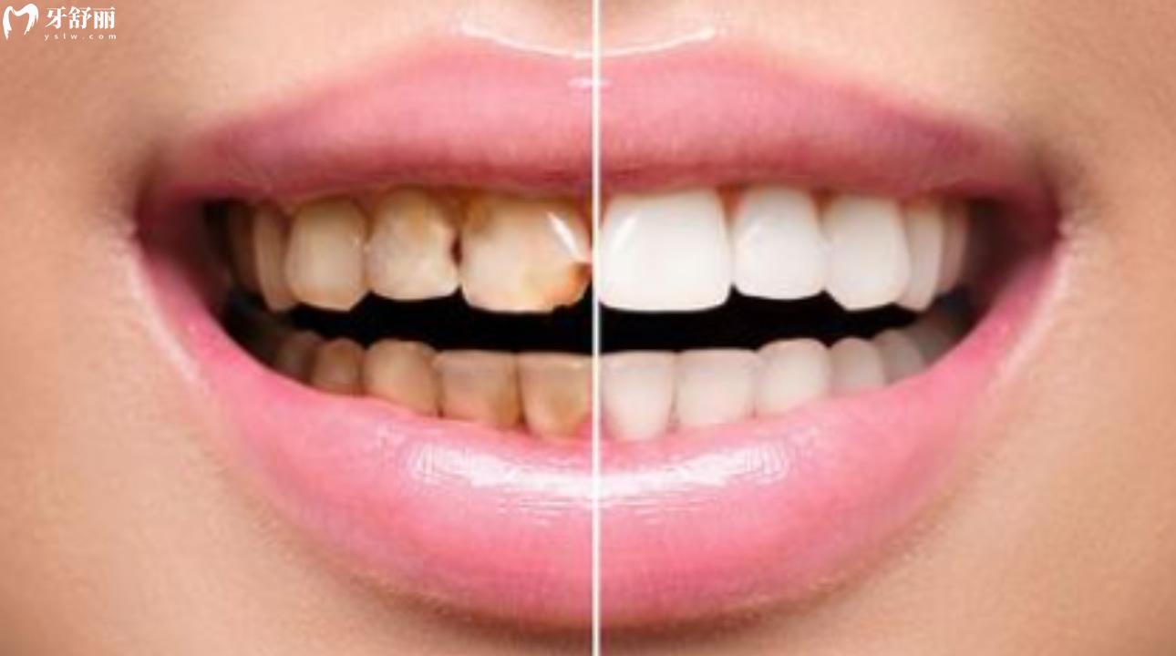 四环素牙做全瓷冠还是瓷贴面好 四环素牙会遗传下一代吗？