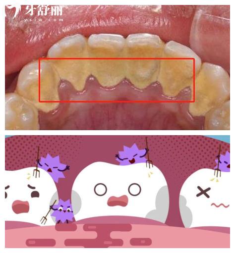 什么是龈下刮治，牙结石为什么会长在牙龈下面？