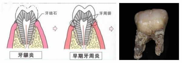什么是龈下刮治，牙结石为什么会长在牙龈下面？