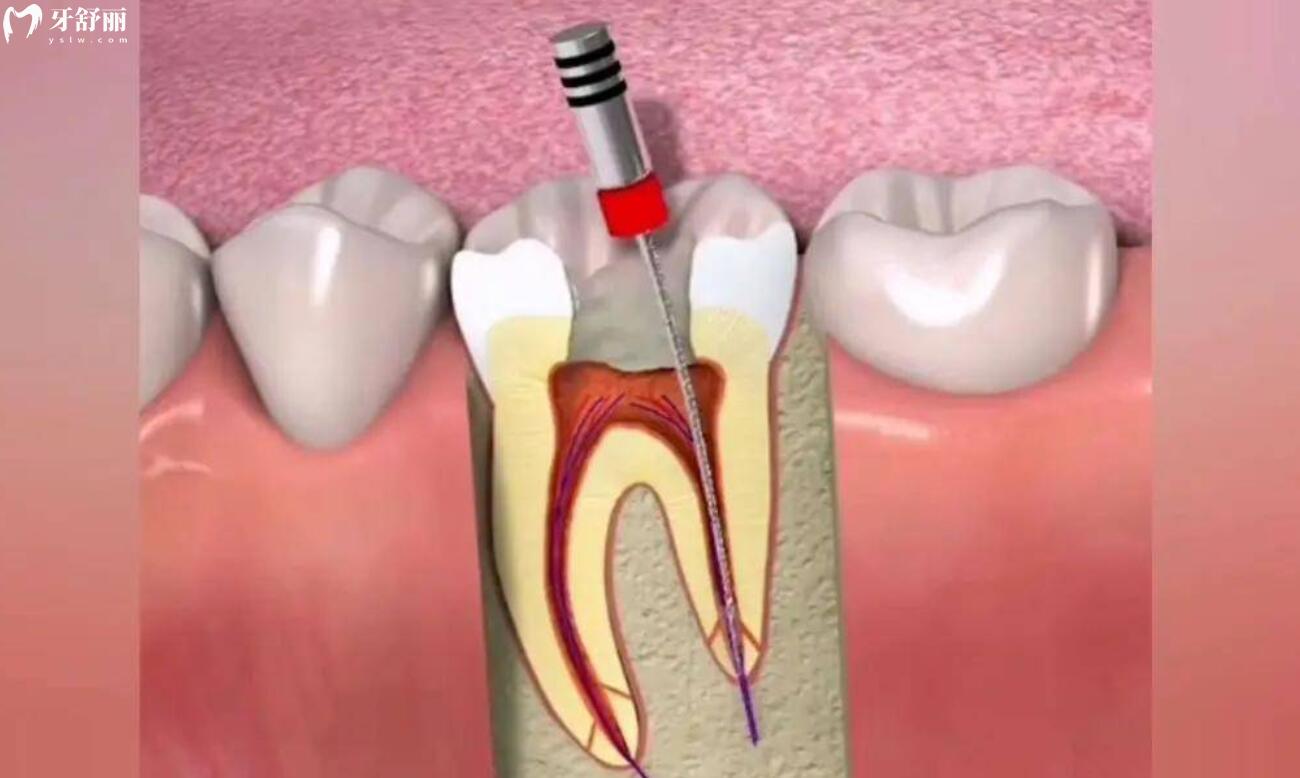 牙齿什么情况下需要做根管治疗？听着过程就很疼的样子