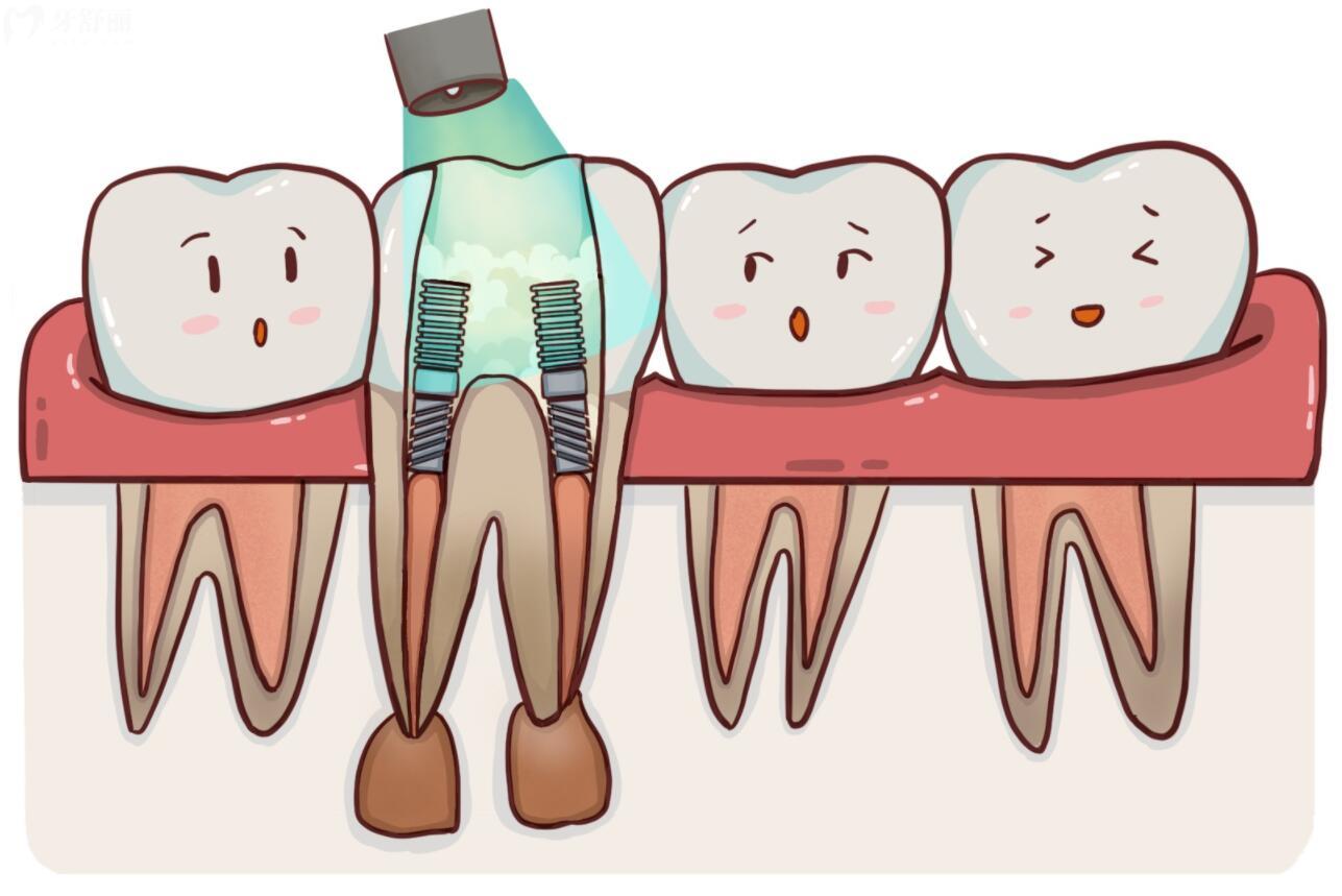 根管治疗三次是做什么？都需要做三次吗？一般需要多长时间