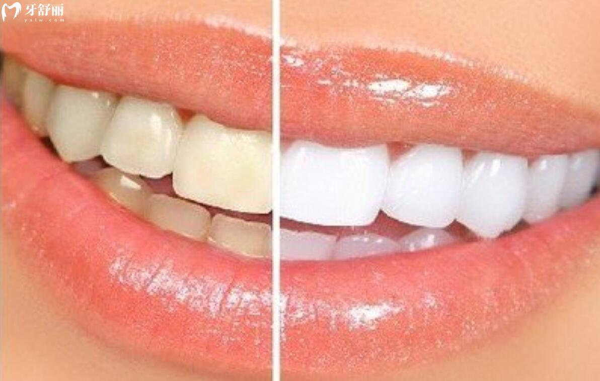 牙齿贴面颜色太黄了还有办法吗？只能拆除还是洗牙就可以