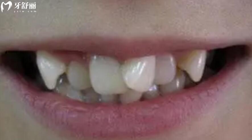 牙齿错位对人体有哪些危害