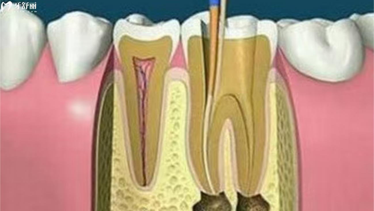 什么情况下牙齿需要做根管治疗.jpg