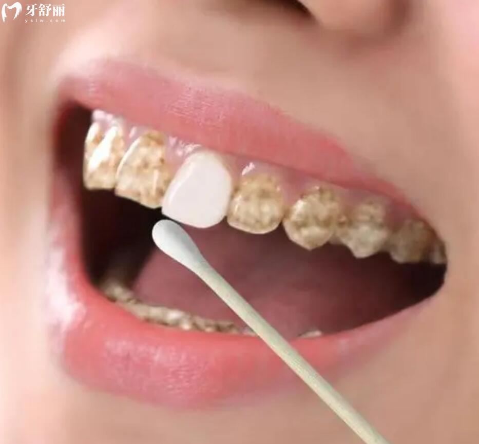 四环素牙是什么样子的？一般都是什么原因引起的怎么治疗