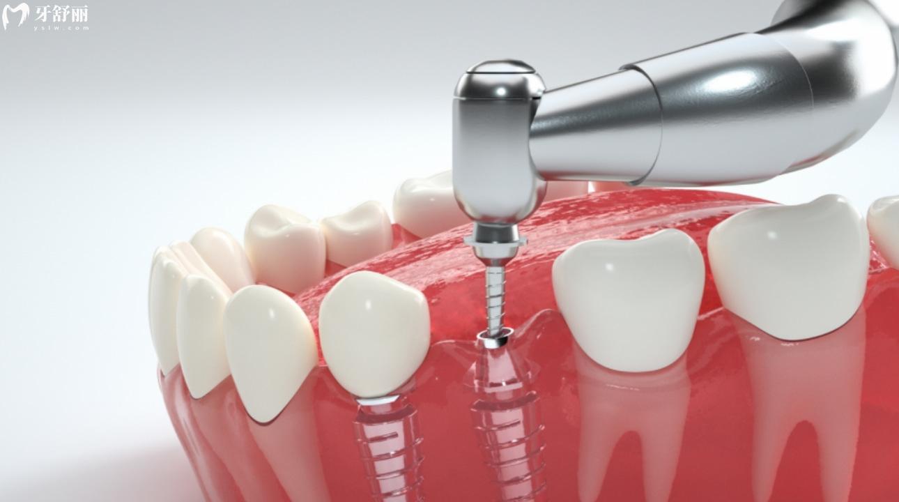 如何识别种植牙真伪 怎么看种植牙植入是否成功呢?