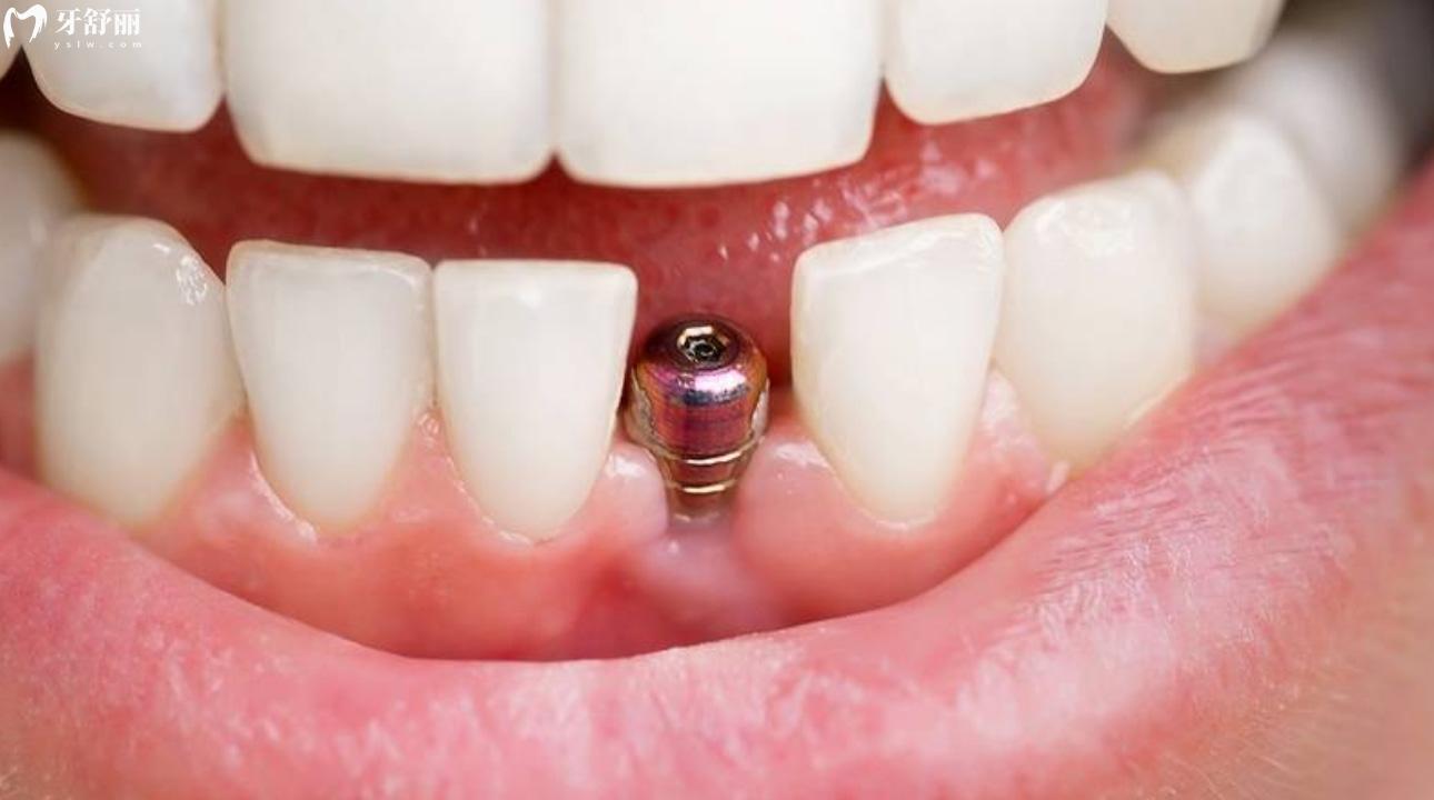 如何识别种植牙真伪 怎么看种植牙植入是否成功呢?