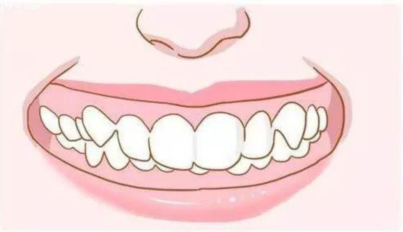 畸形儿牙的早期预防.jpg