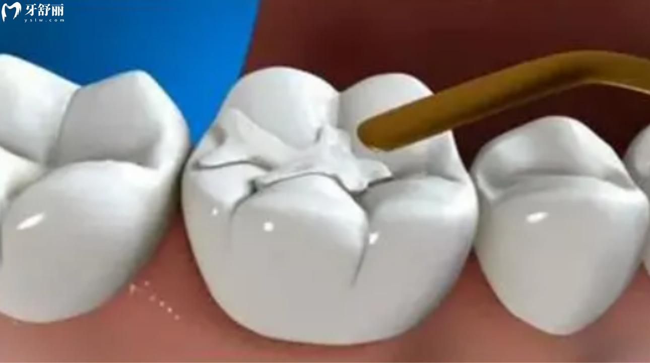 深圳佳茗口腔诊所怎么样?亲诊种牙矫牙不贵靠谱
