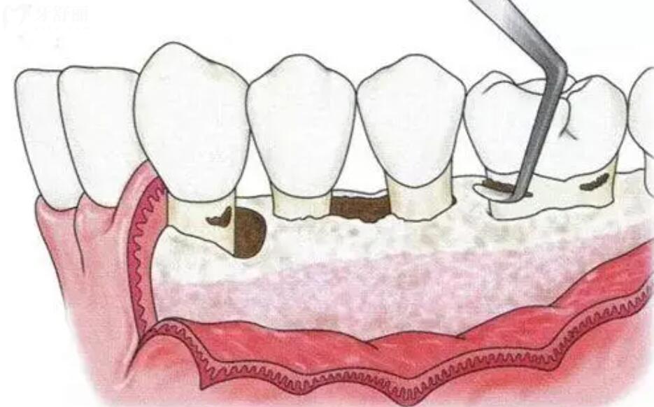 什么情况下做牙龈翻瓣术?牙医说我的牙齿需要做但是有点害怕