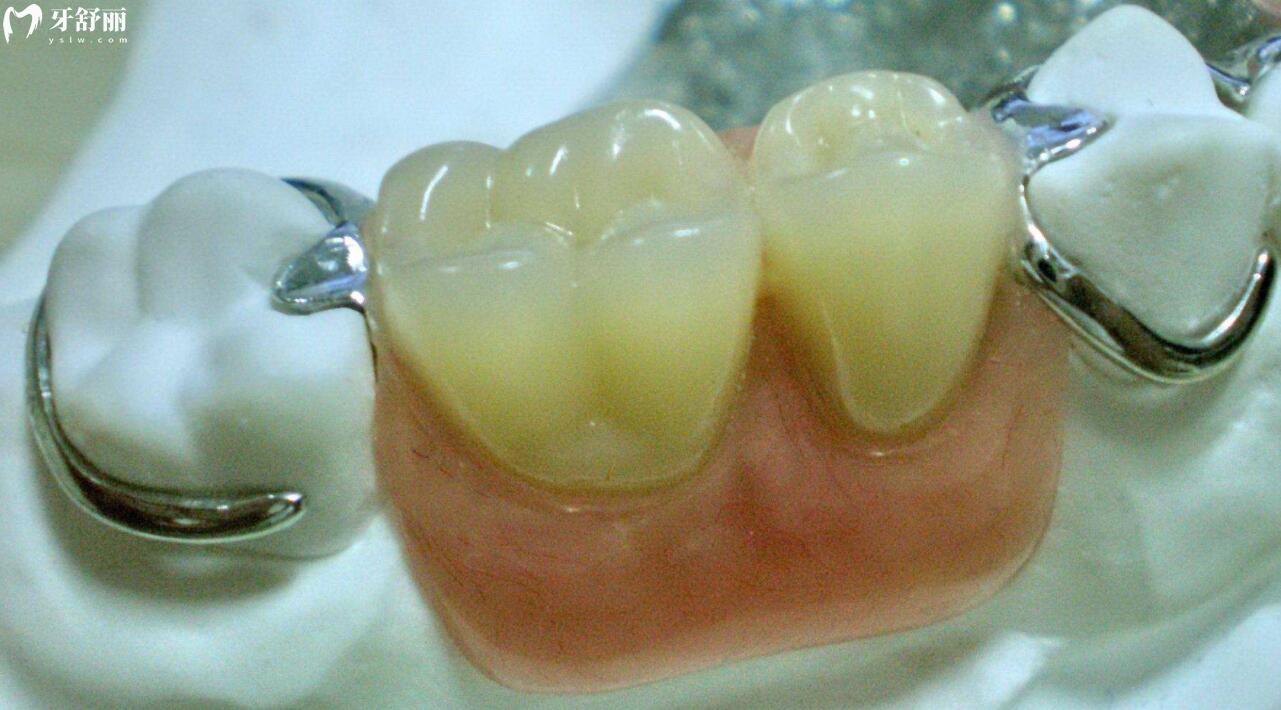 六十岁老人种牙好还是镶牙好?应该怎么选择才能拥有健康口腔