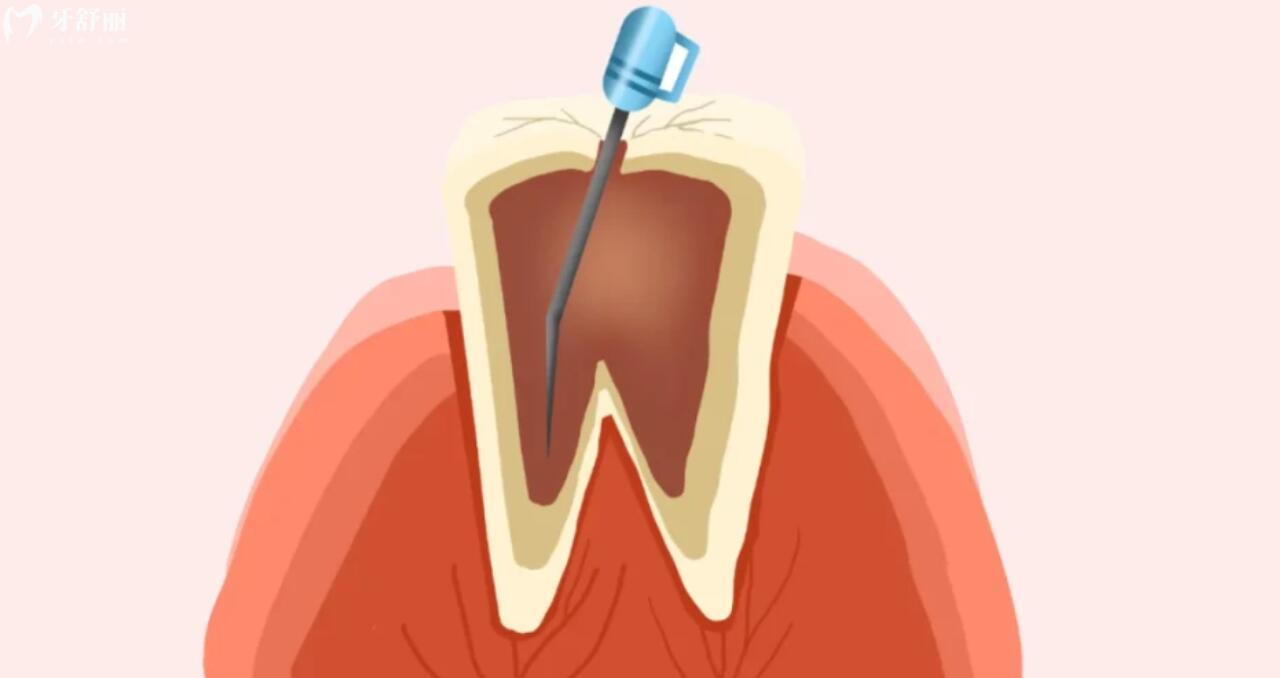 根管治疗和种植牙的区别有哪些？怎样选择才合适
