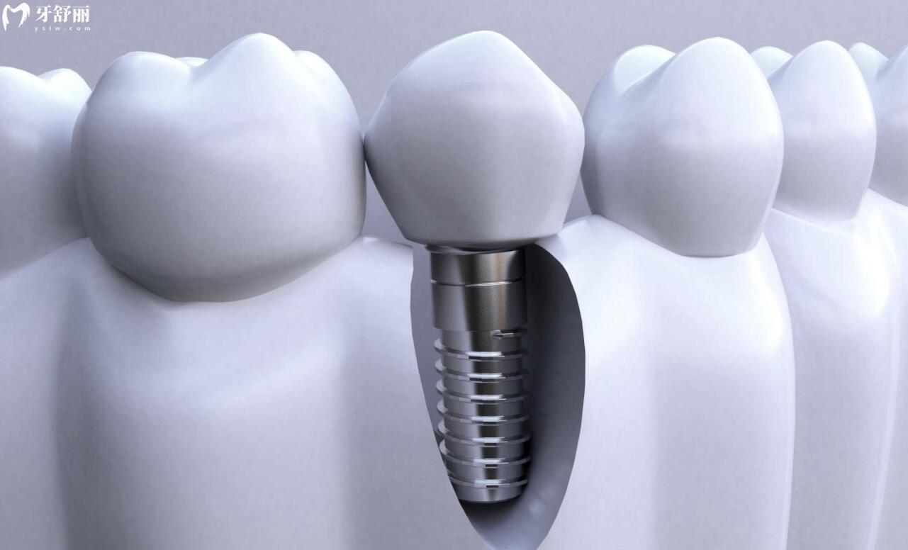 根管治疗和种植牙的区别有哪些？怎样选择才合适