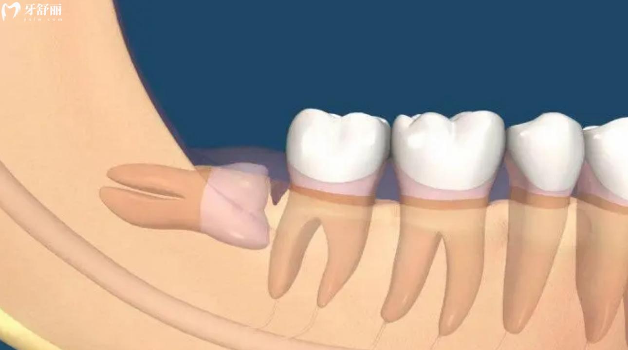 风水里说长了4颗智齿是什么命运 长了四颗智齿都要拔吗?