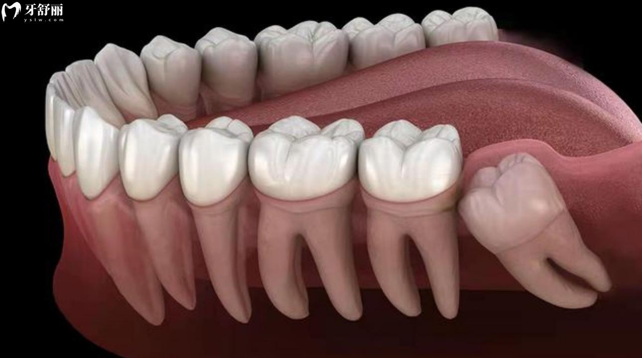 风水里说长了4颗智齿是什么命运 长了四颗智齿都要拔吗?