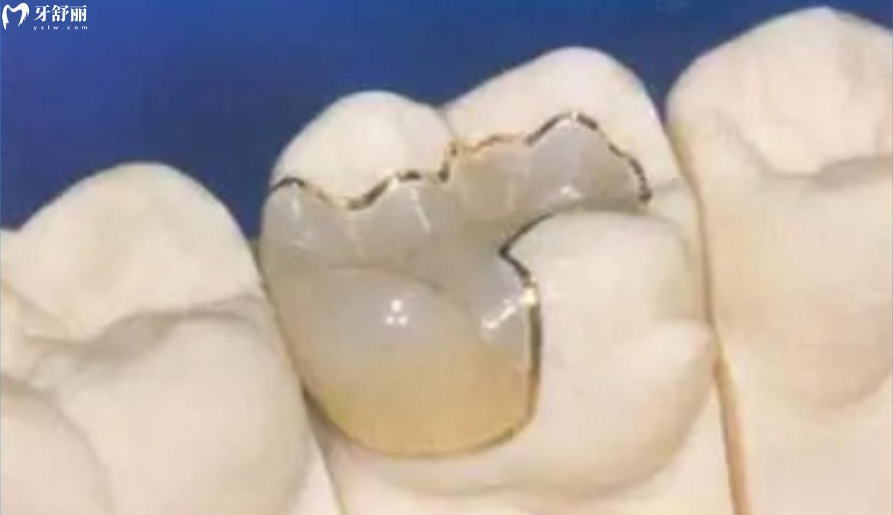 牙齿嵌体和补牙区别在哪里.jpg