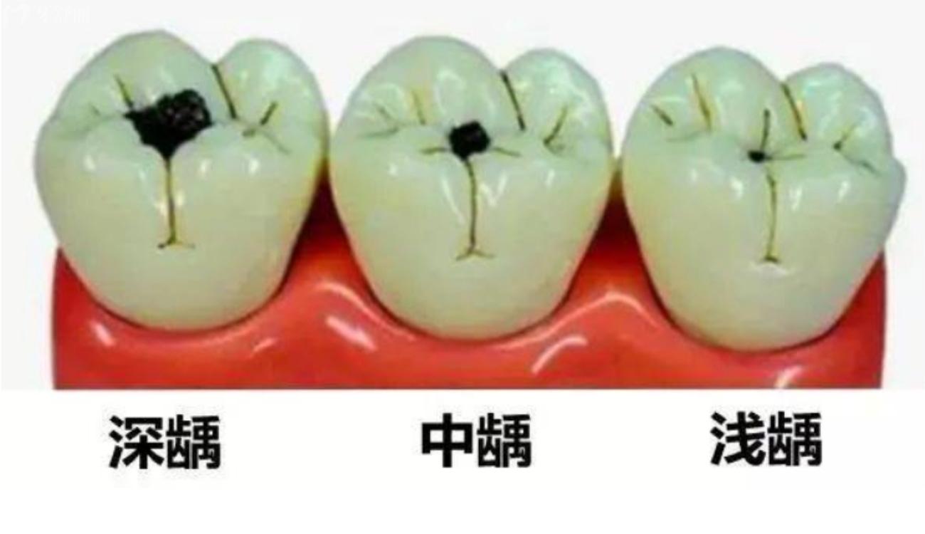 补牙如何防止被牙医骗.jpg