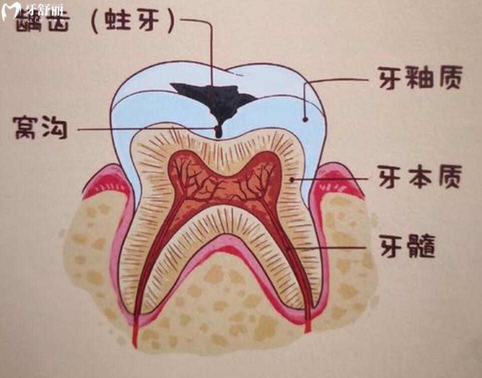 牙髓坏死不治疗会有什么后果？应该怎么办才好
