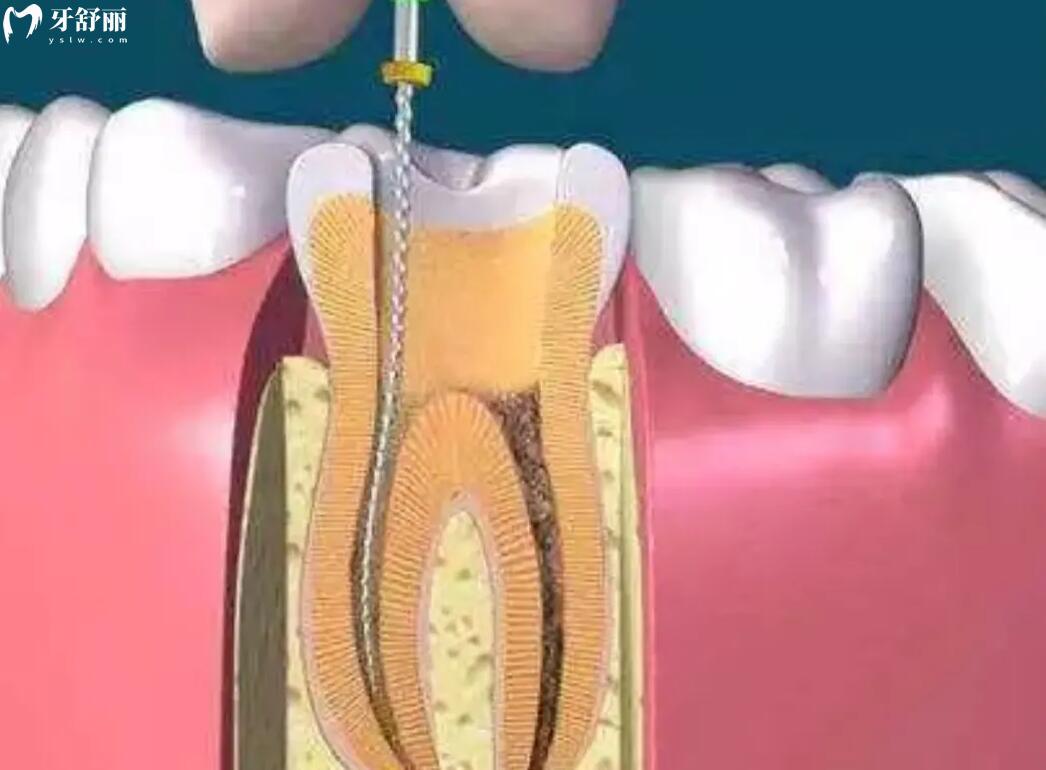 牙髓坏死不治疗会有什么后果？应该怎么办才好