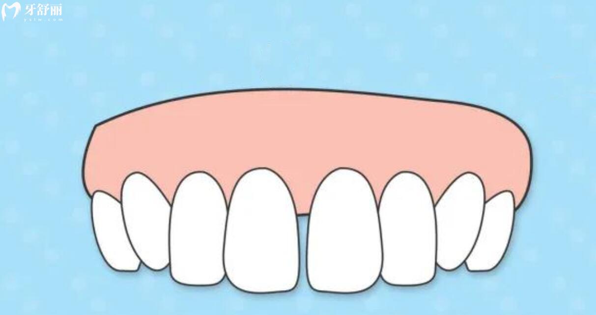 门牙缝隙变大是什么原因引起的？都有什么方法可以改善