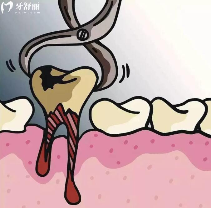 智齿拔除后的牙洞怎么办?还能吃东西吗?多久才可以长平