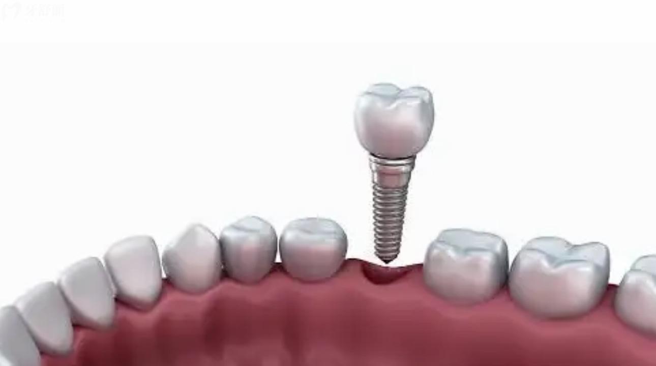 人工骨粉填充牙齿后悔死了 人工骨粉填充牙齿危害有哪些？