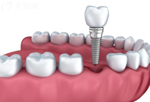 口腔医院种植牙价目表，种植牙多少钱一颗2023年
